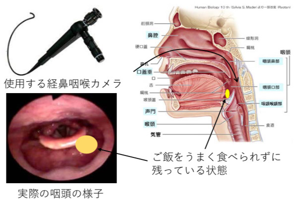 嚥下内視鏡検査(VE)