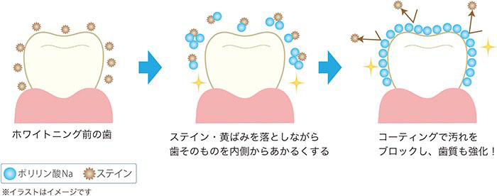 ポリリン酸ホワイトニング